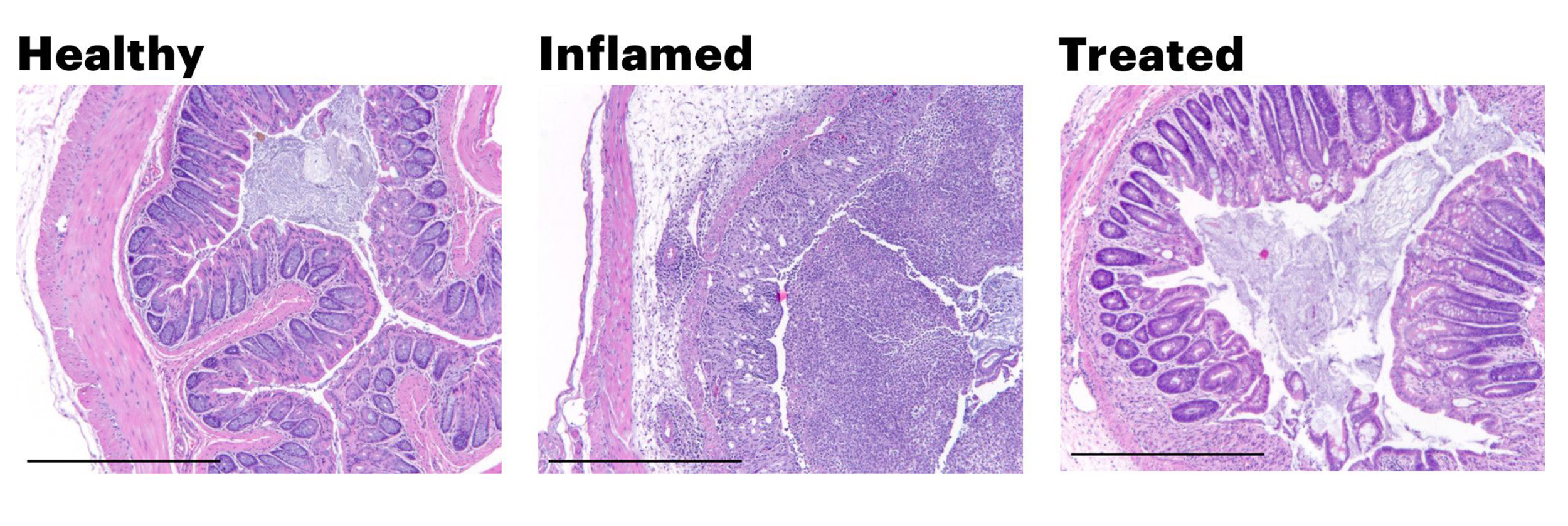 Graphic showing healthy and diseased colons.