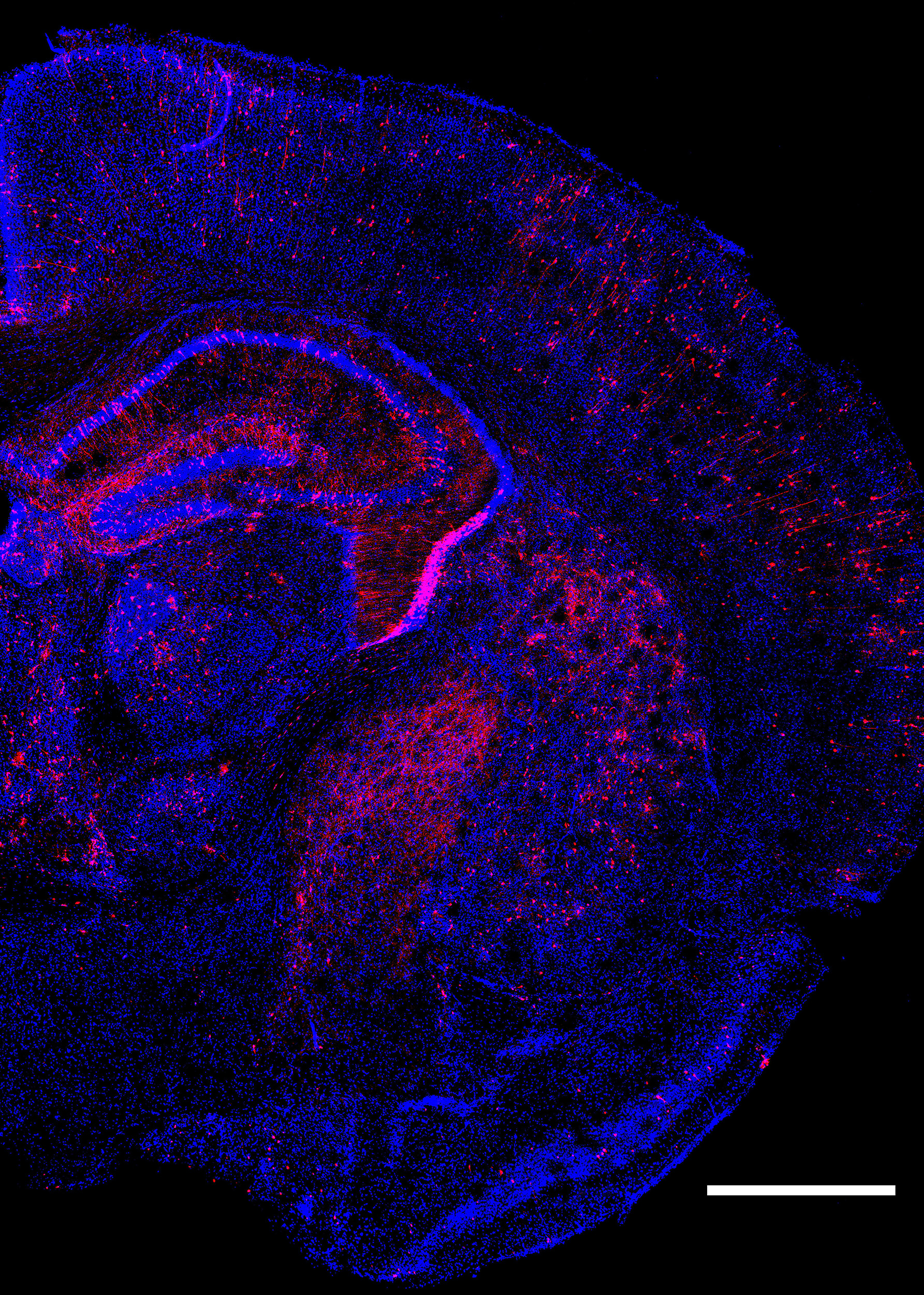 Multiple genetic changes to cells.