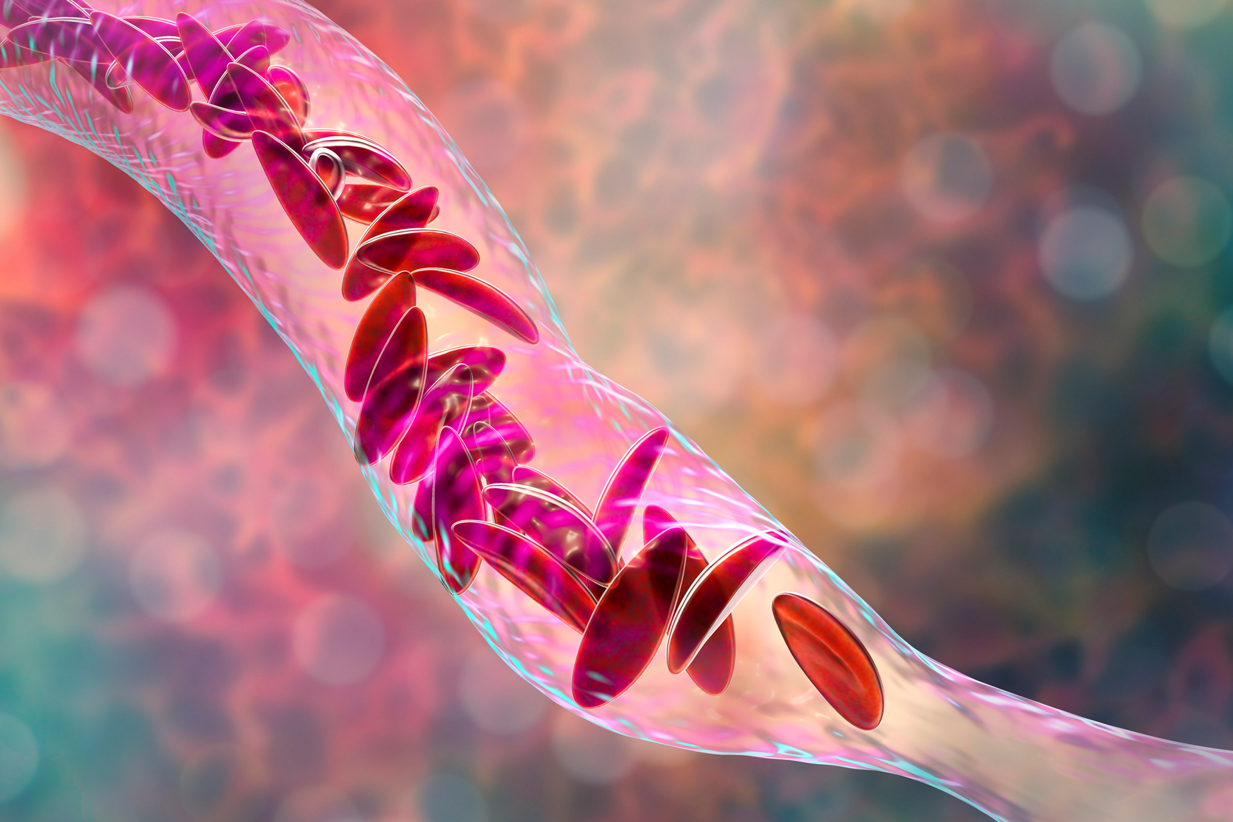 Sickle cell anemia, 3D illustration.