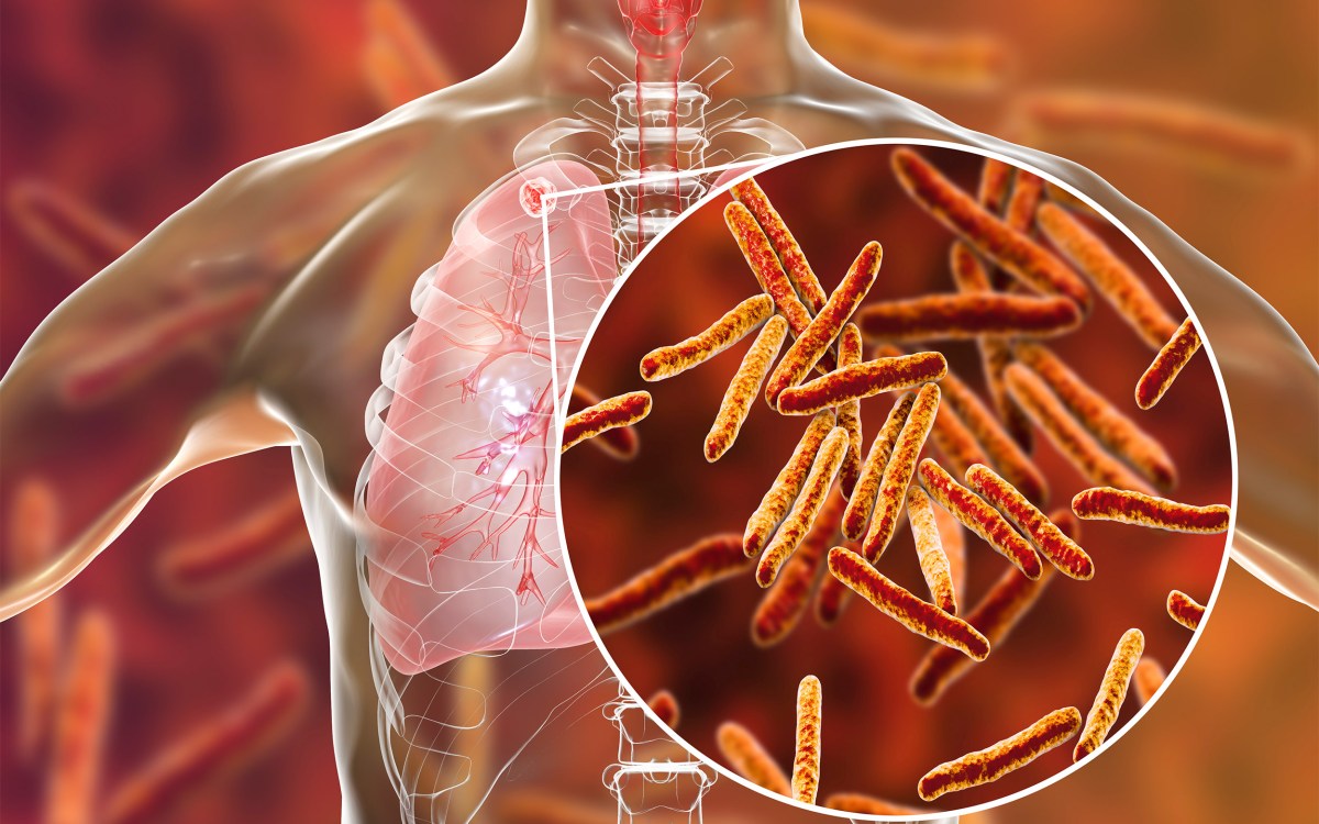 Secondary tuberculosis in lungs and close-up view of Mycobacterium tuberculosis bacteria, 3D illustration