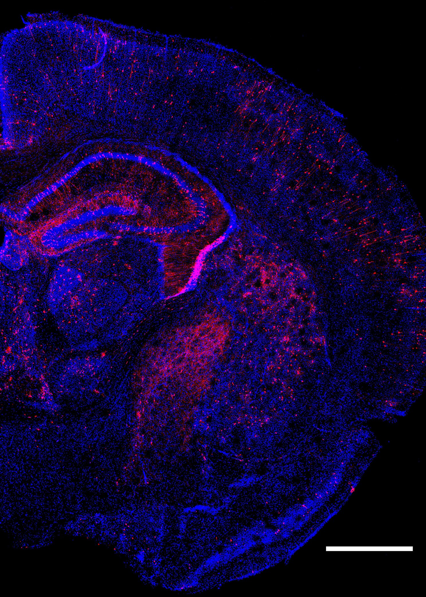Multiple genetic changes to cells.