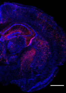 Multiple genetic changes to cells.