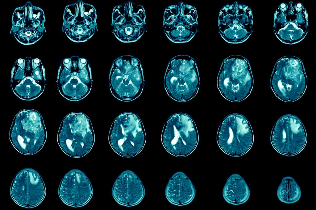 MRI showing glioblastoma.