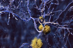 This illustration shows neurons with amyloid plaques, a hallmark of Alzheimer’s disease, in yellow.