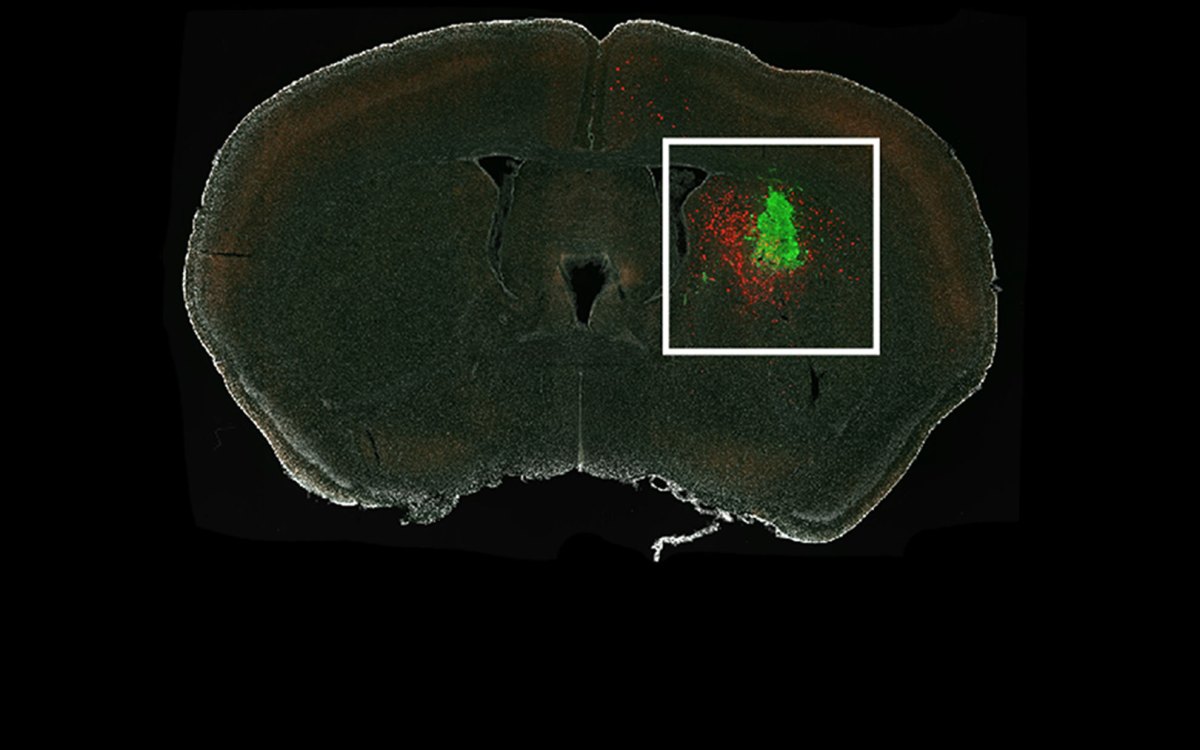 Researchers revealed which neurons in a mouse brain, shown in red, connect to a human glioma, shown in green.