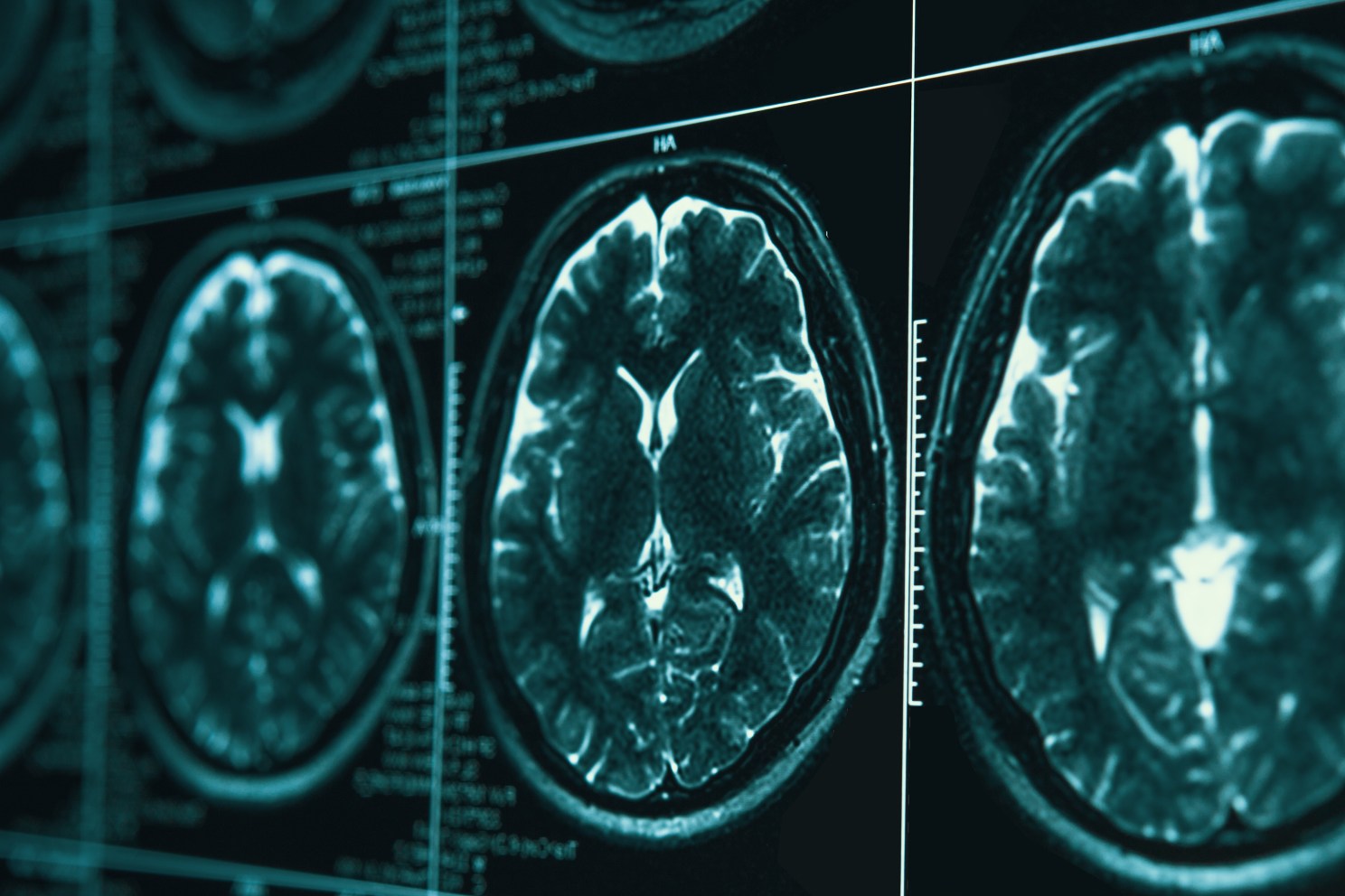 brain scnas